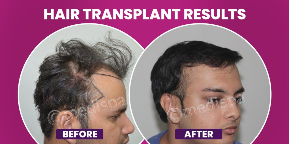 Is Hair Restoration The Best Solution For Genetic Baldness?