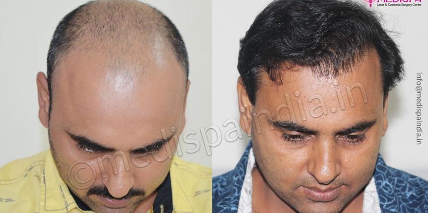 hair transplant surgeons in faridabad