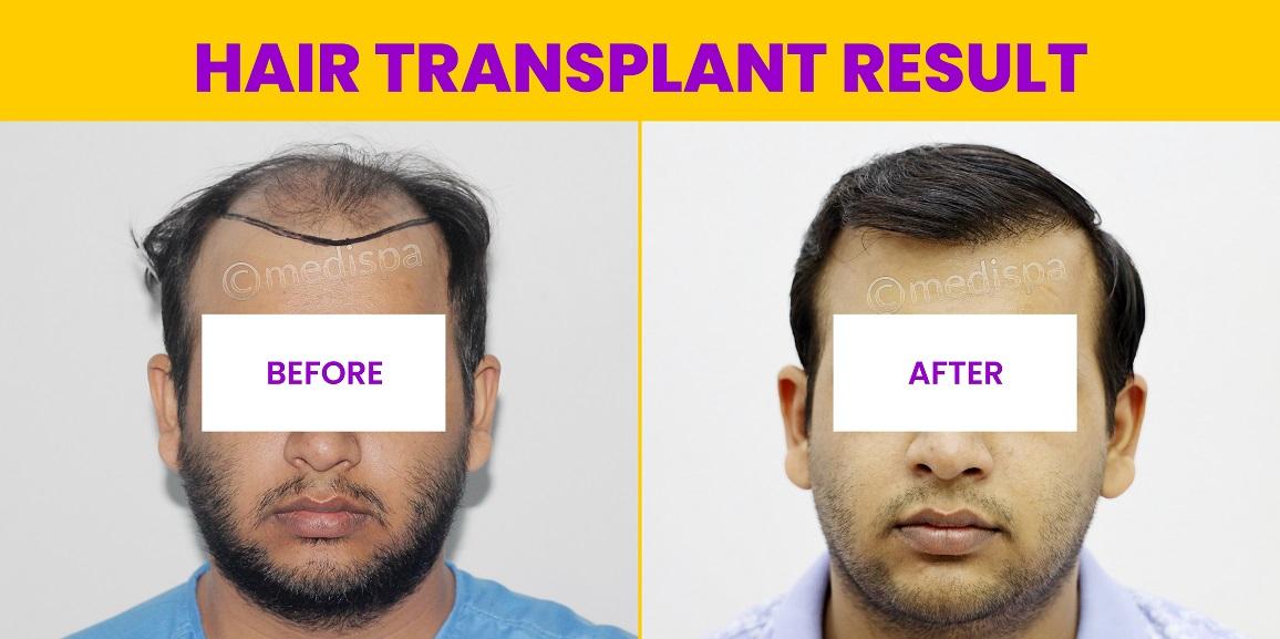 How Many Grafts Are Needed For Hair Transplant?