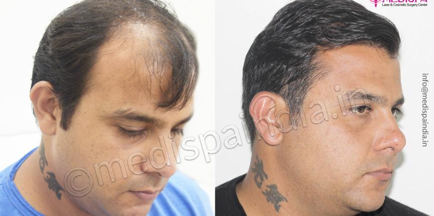 hair transplant in odhisha