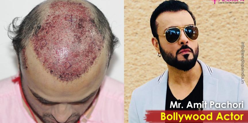 best hair transplant results in india