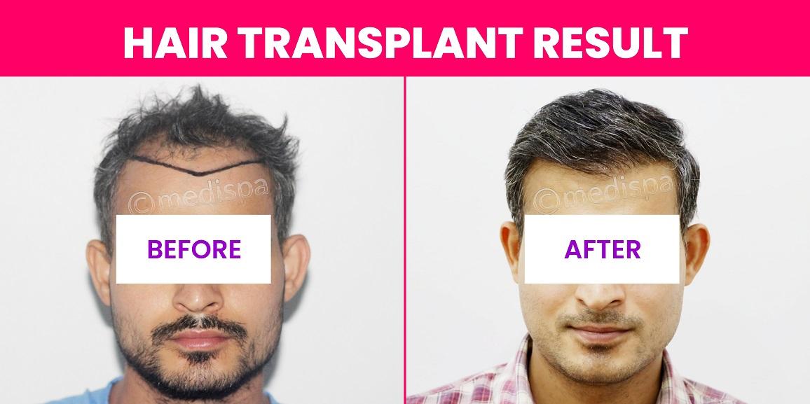 Can Hair Transplant Effective On Grey Hair?