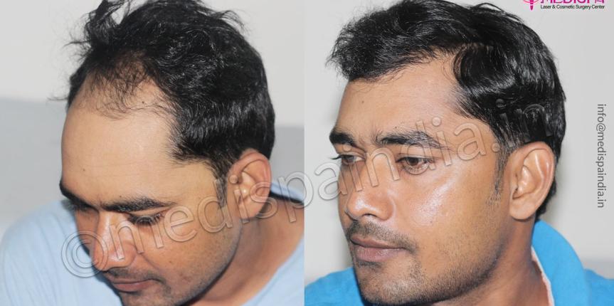 male hair transplant before after results