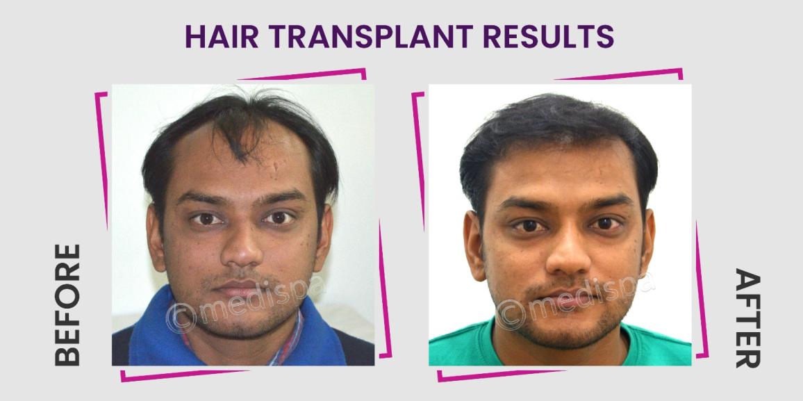 How To Achieve Natural Hairline By Hair Transplantation?