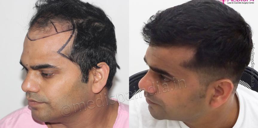 hair restoration results india