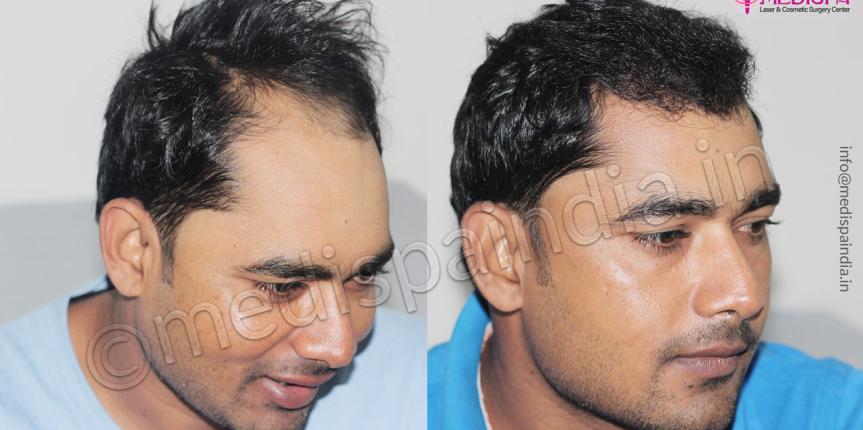 male hair transplant before and after