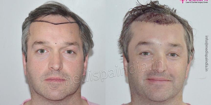 hair restoration uk results