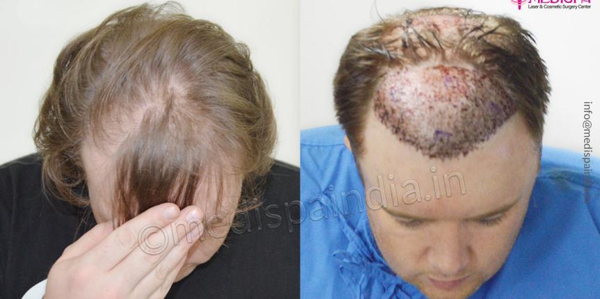 hair transplant in usa