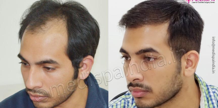 hair transplant in karnal