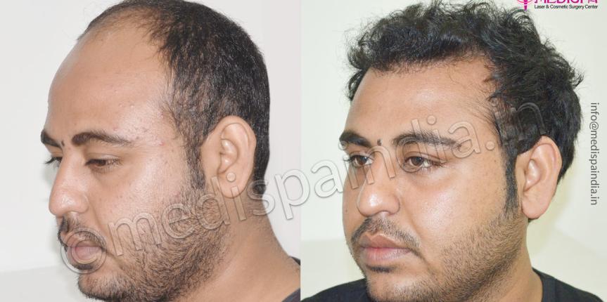 hair transplant cost in dehradun