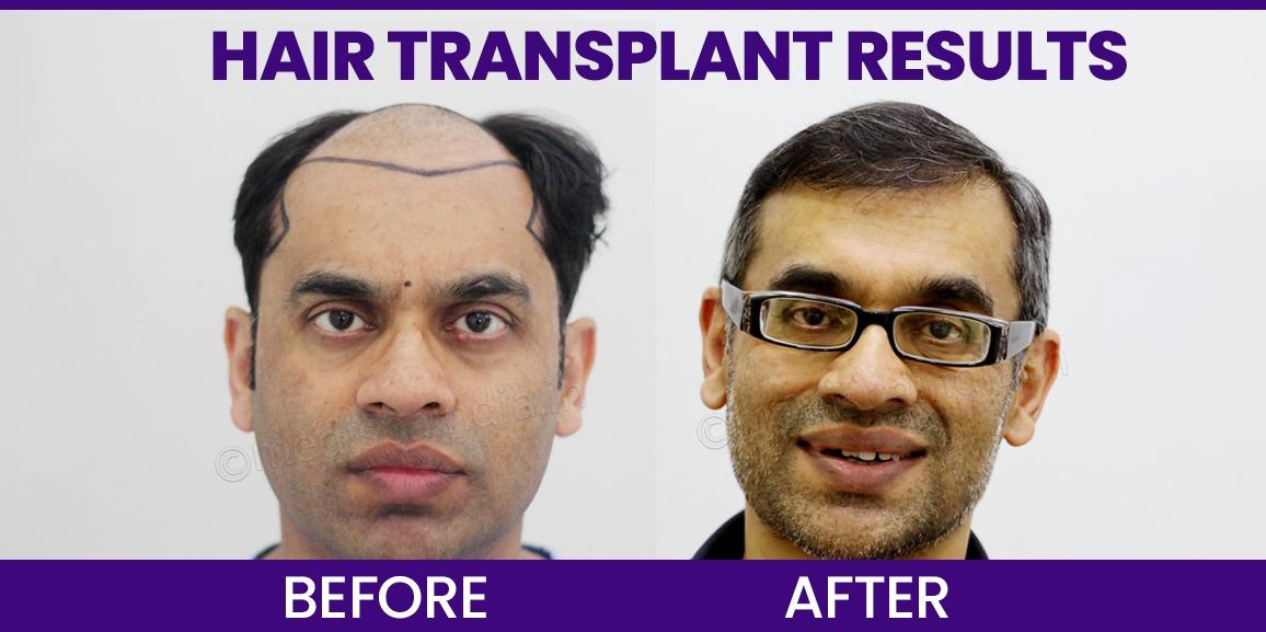 Understanding Hair Transplant Procedure And Expected Results