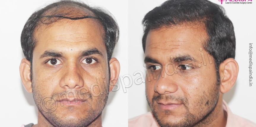 hair transplant before after results