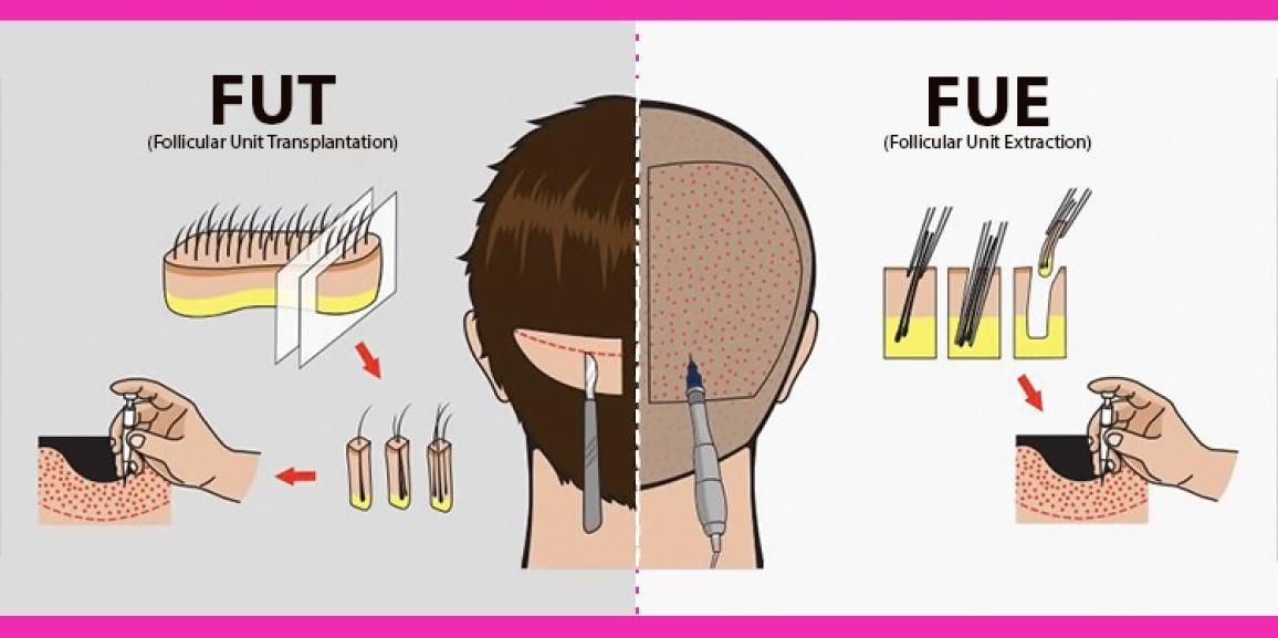 Why The Graft Damage In FUT Is Less As Compared To FUE?