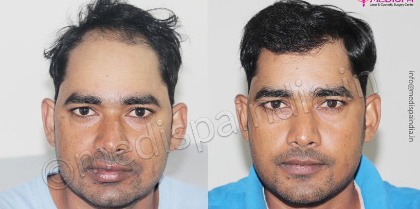 male hair transplant before after