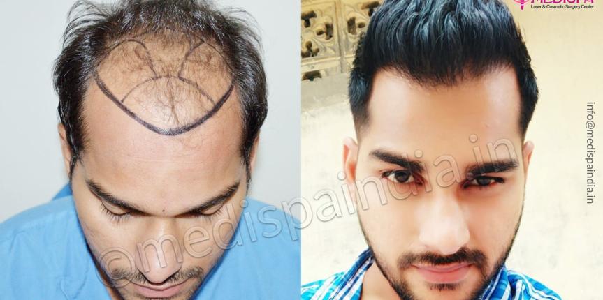 results hair transplant