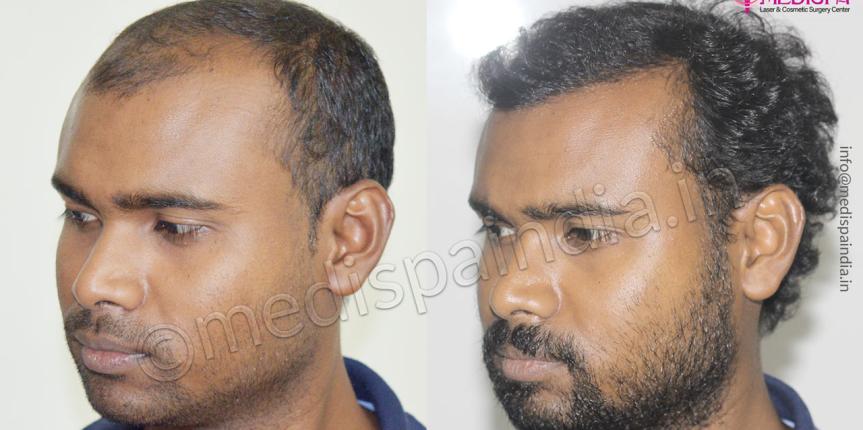 hair transplant cost in bengaluru