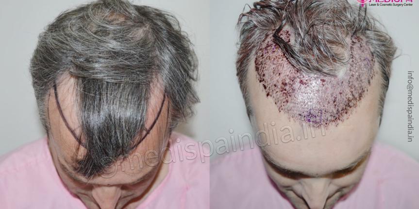 hair transplant results