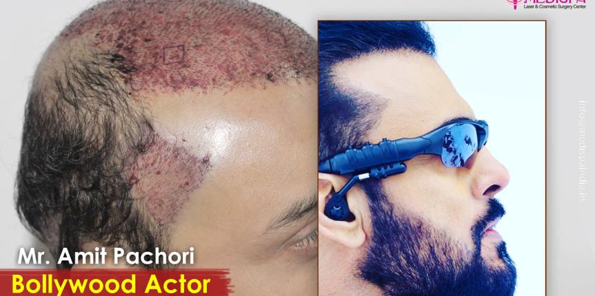 actor hair transplant results india