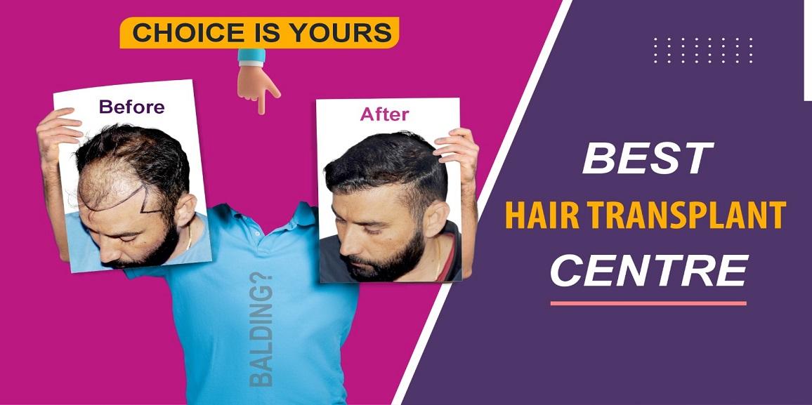 When Should I Undergo Hair Transplant Surgery?