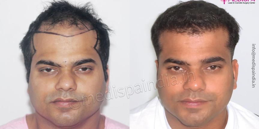 hair transplant results jaipur india