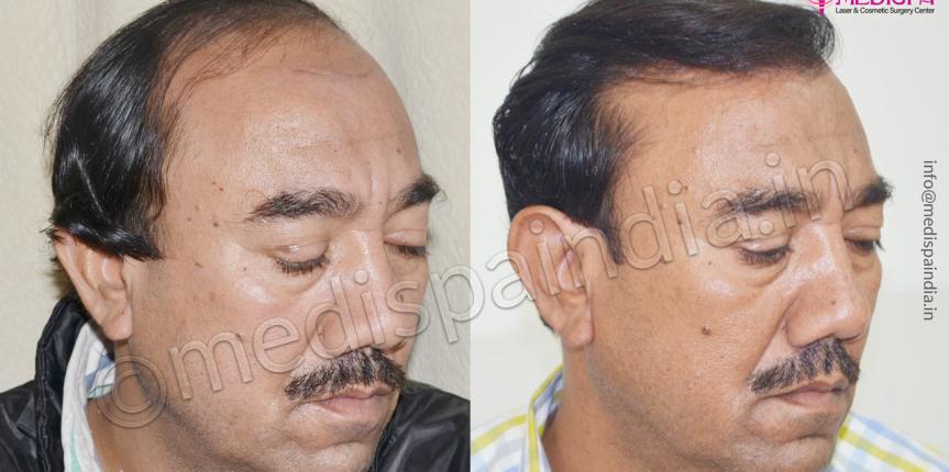 hair transplant in jammu and kashmir