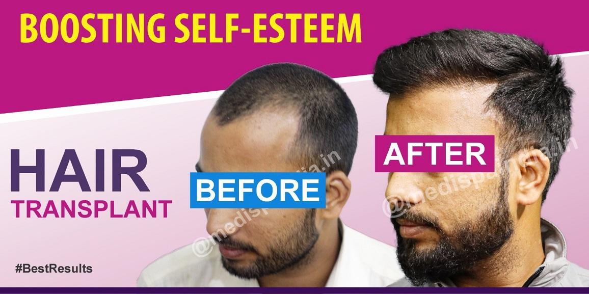 How To Get Safe Hair Transplant Treatment For Hair Loss Issue?