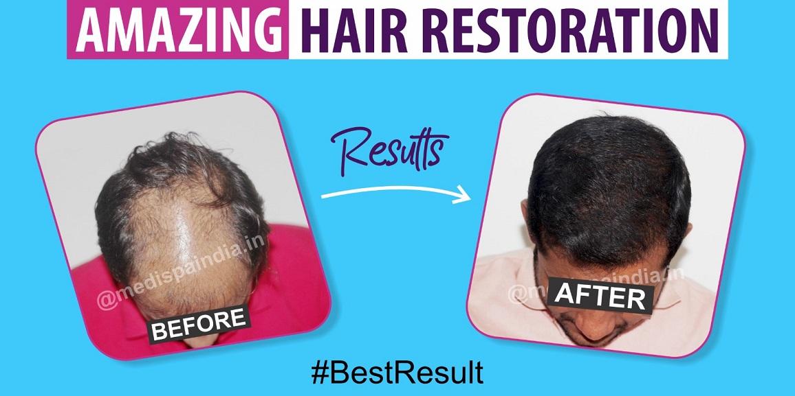 All You Need To Know About High Grade Baldness And Its Treatment