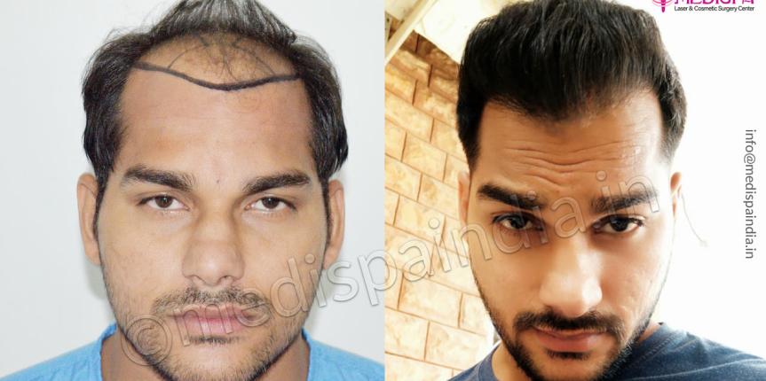 before after hair transplant