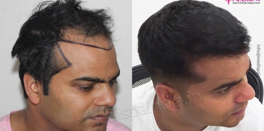 hair transplant before after jaipur india