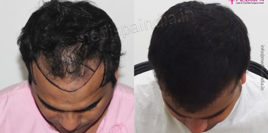 hair transplant before and after results