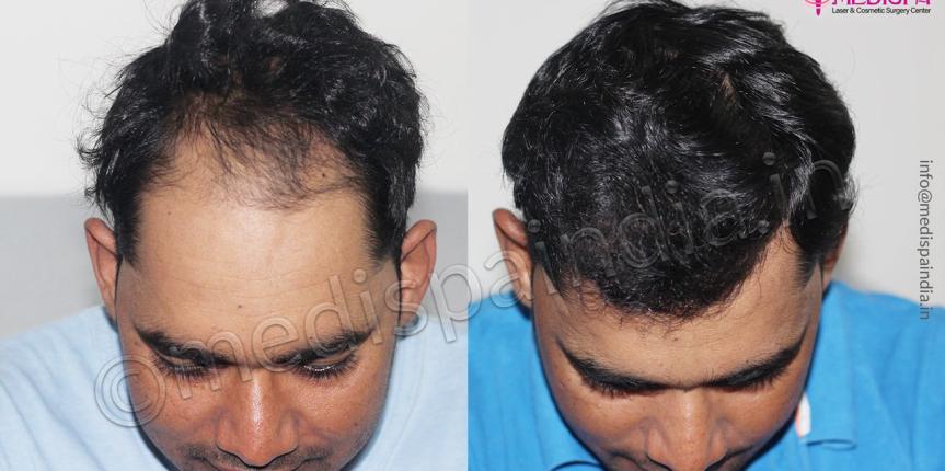 male hair transplant before after-1-year