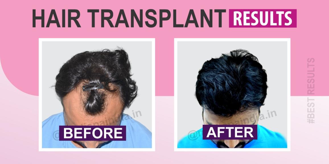 Does The expertise of The Surgeon Influence The Results of Hair Transplant?