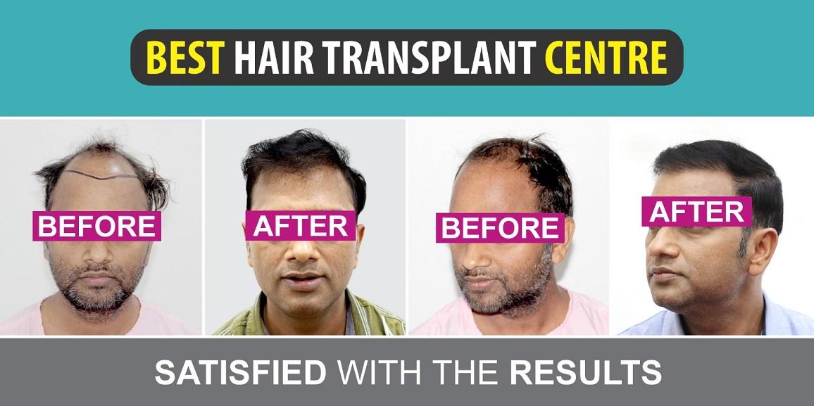 Does Hair Transplant Help To Get Over Higher Grade Of Baldness?