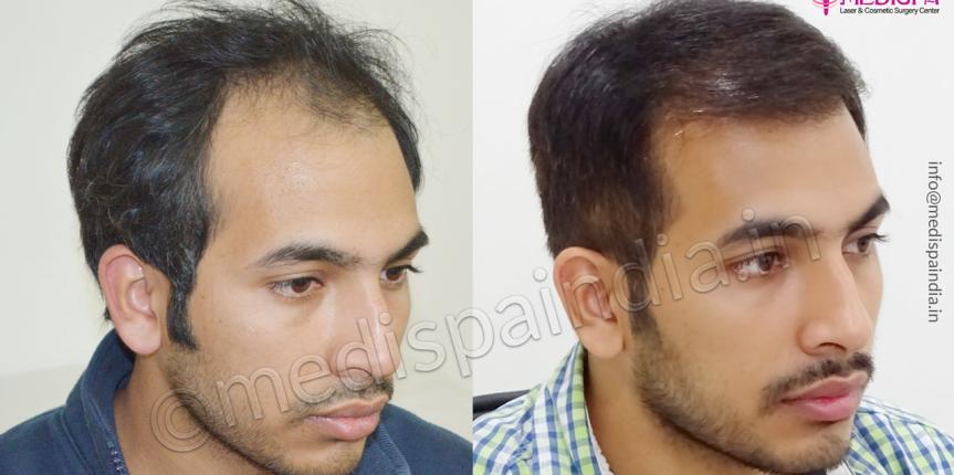 hair transplant ambala