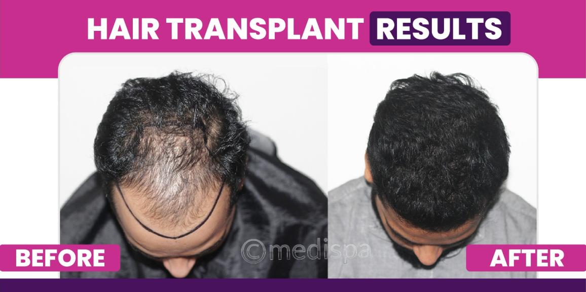 How To Determine If You Are An Ideal Candidate For Hair Restoration?