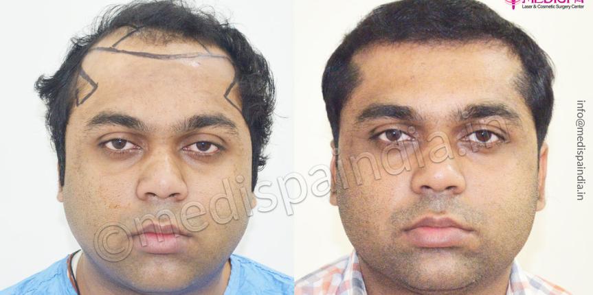 hair transplant london cost