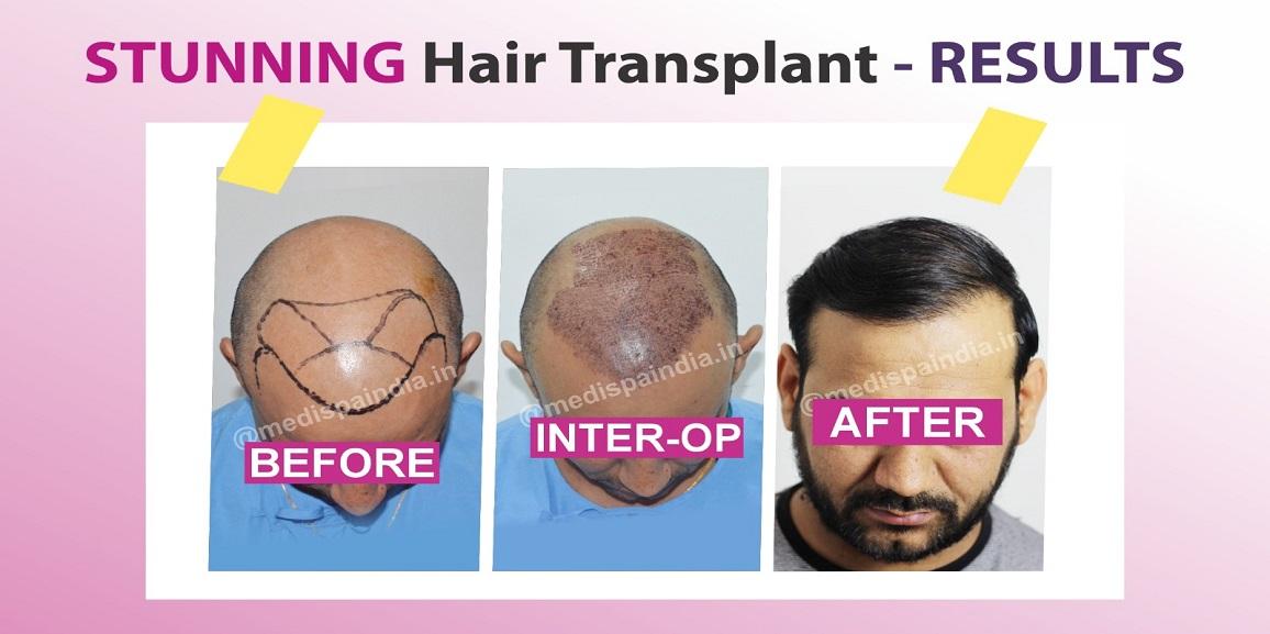 Why Scalp Assessment is Mandatory Before Hair Transplant?