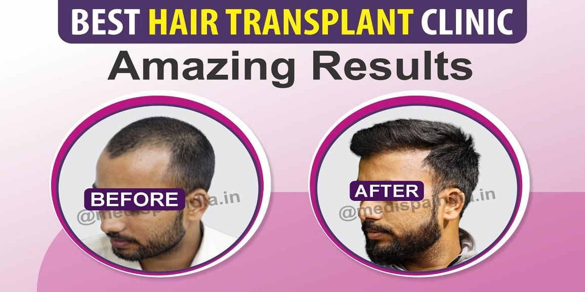 Explain The Characteristics of A Good Hair Transplant Surgeon